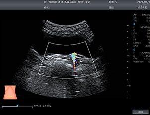 Bladder Stone - Color Flow