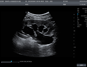 Kidney  Hydronephrosis