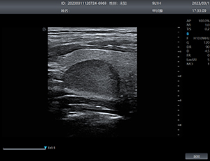 Thyroid  Nodes